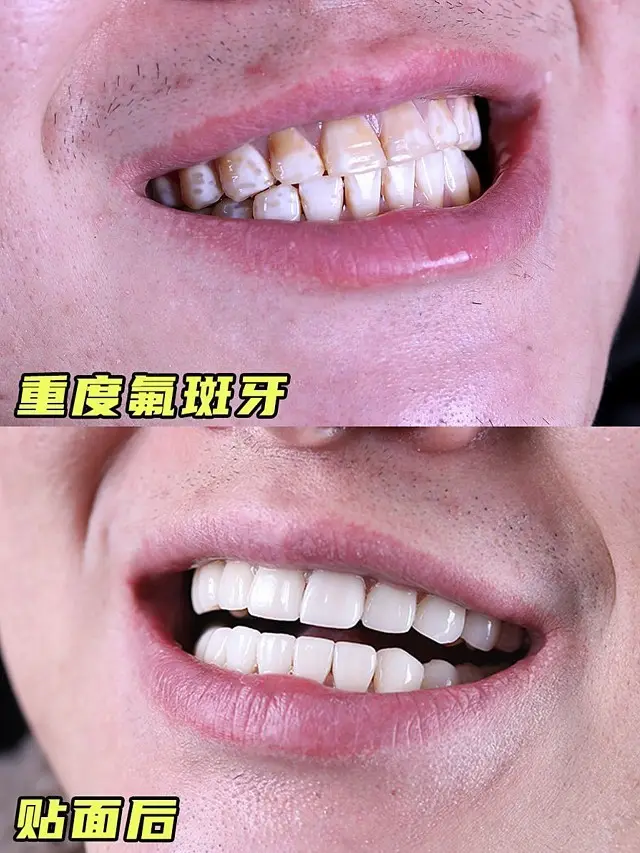 氟斑牙对比图-上海中博惠众口腔医院